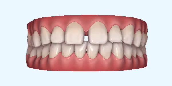 Gapped teeth